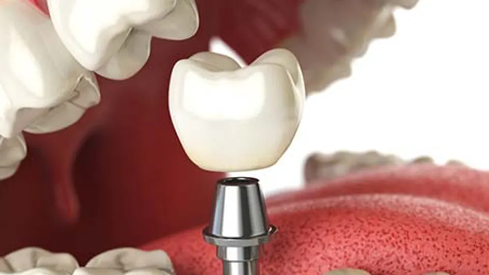 Holladay Hills Dental - Dentist in Murray, UT