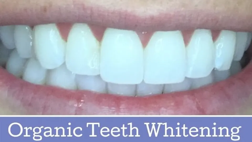 Idahome Smiles - Teeth whitening service in Boise, ID