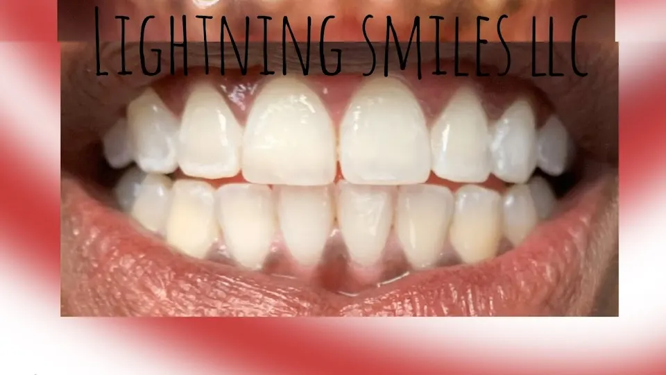 Lightning Smiles LLC - Teeth whitening service in Houma, LA