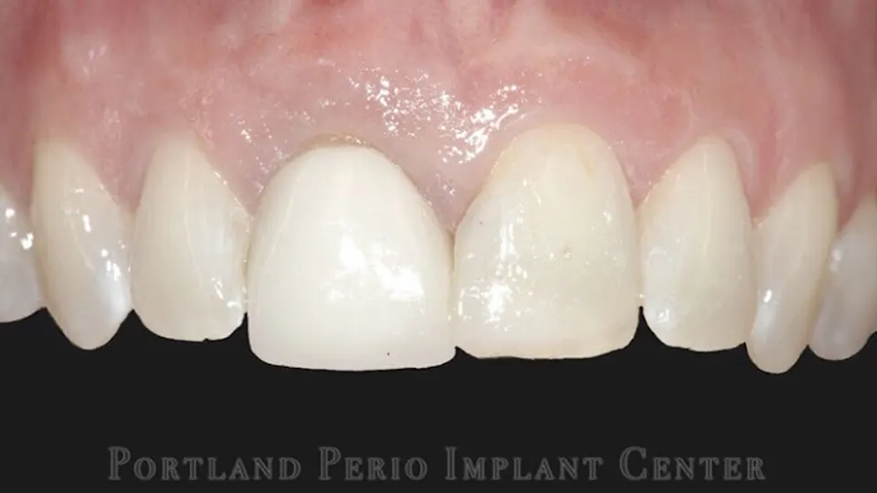 Portland Perio Implant Center - Dental implants periodontist in Portland, OR